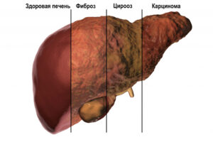 Гепатит менен күрөшүүгө учур келди