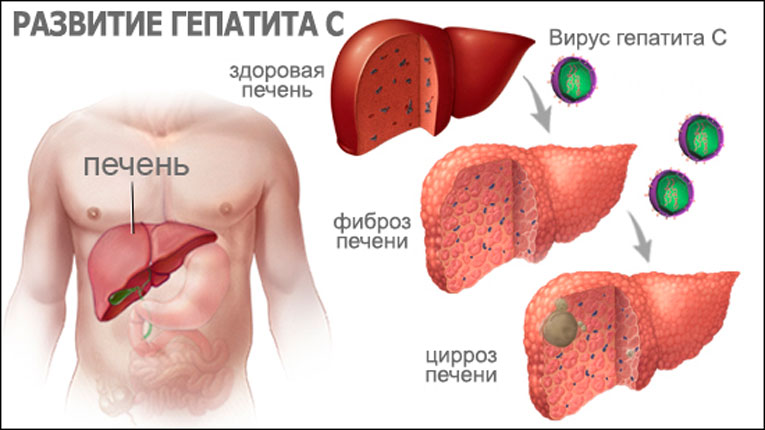 Гепатит менен күрөшүүгө учур келди
